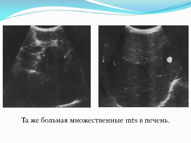 Та же больная множественные mts в печень.